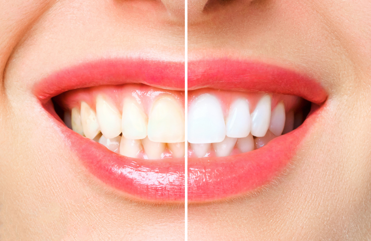 You are currently viewing הלבנת שיניים: מחיר, יתרונות וחסרונות